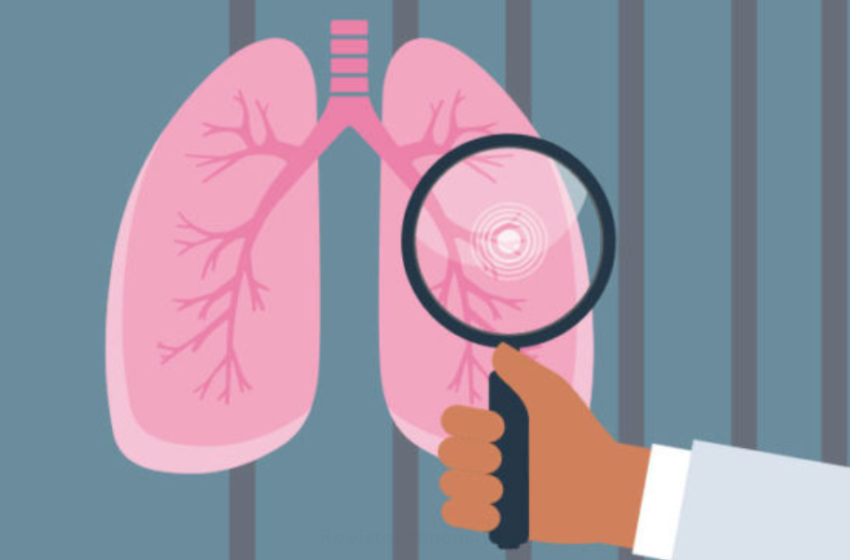 Cáncer de pulmón: si no fuma, aún puede contraerlo