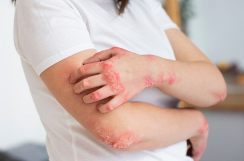 Sun Pharma revoluciona el tratamiento de la psoriasis en Perú con ILUMYA