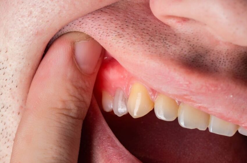 Día Mundial de las Encías: Enfermedades periodontales pueden agravar cuadros cardíacos, diabetes y embarazo
