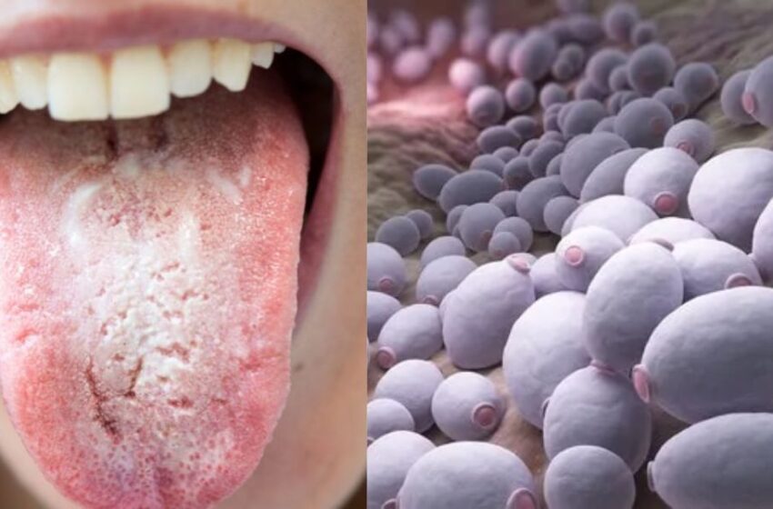 Candida: dietas y remedios naturales se posicionan como aliados en el control de infecciones fúngicas