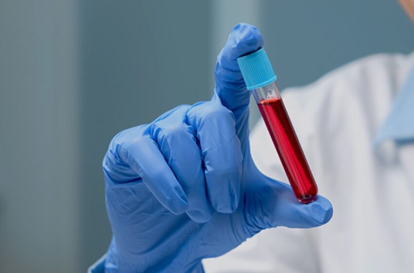 Urea elevada en sangre: el silencioso signo que tu cuerpo no debe ignorar