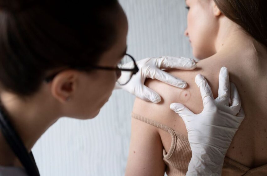 Más que una mancha: Señales de cáncer de piel que no debe ignorar